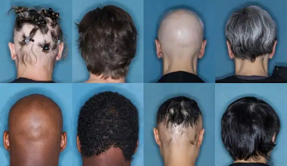 ynews alopecia 1 » Gnews Bahia