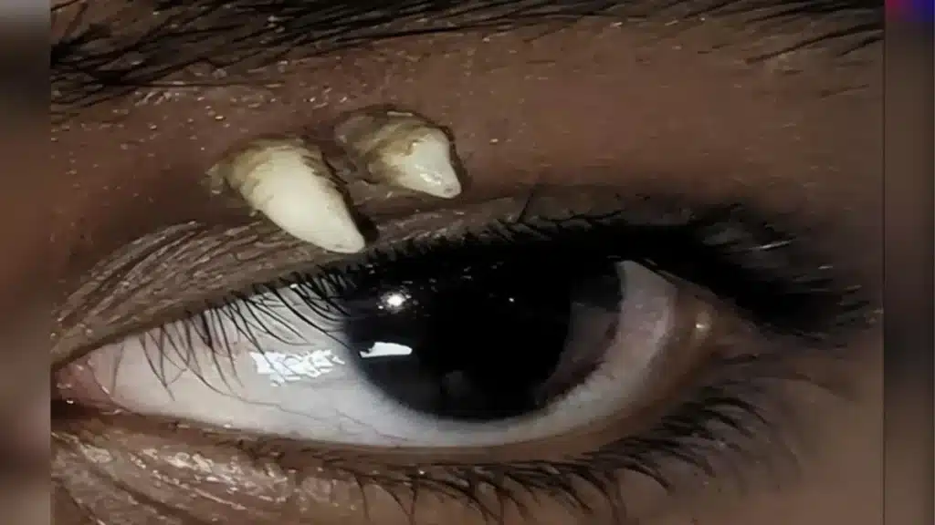Dente ectopico de adolescente &raquo; Gnews Bahia